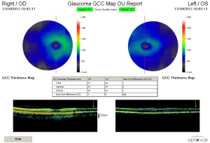 GCC glaucoma sleep apnea